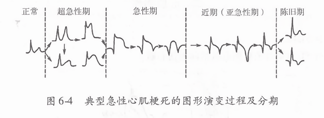 梗塞最新分期及診療策略調(diào)整概述